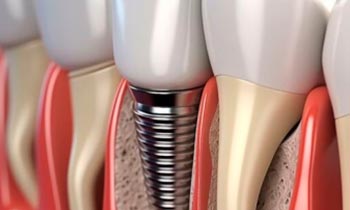 Limitovaná akce na zubní implantáty
