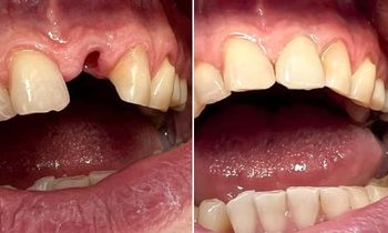 Zubní implantáty v létě s 25% slevou
